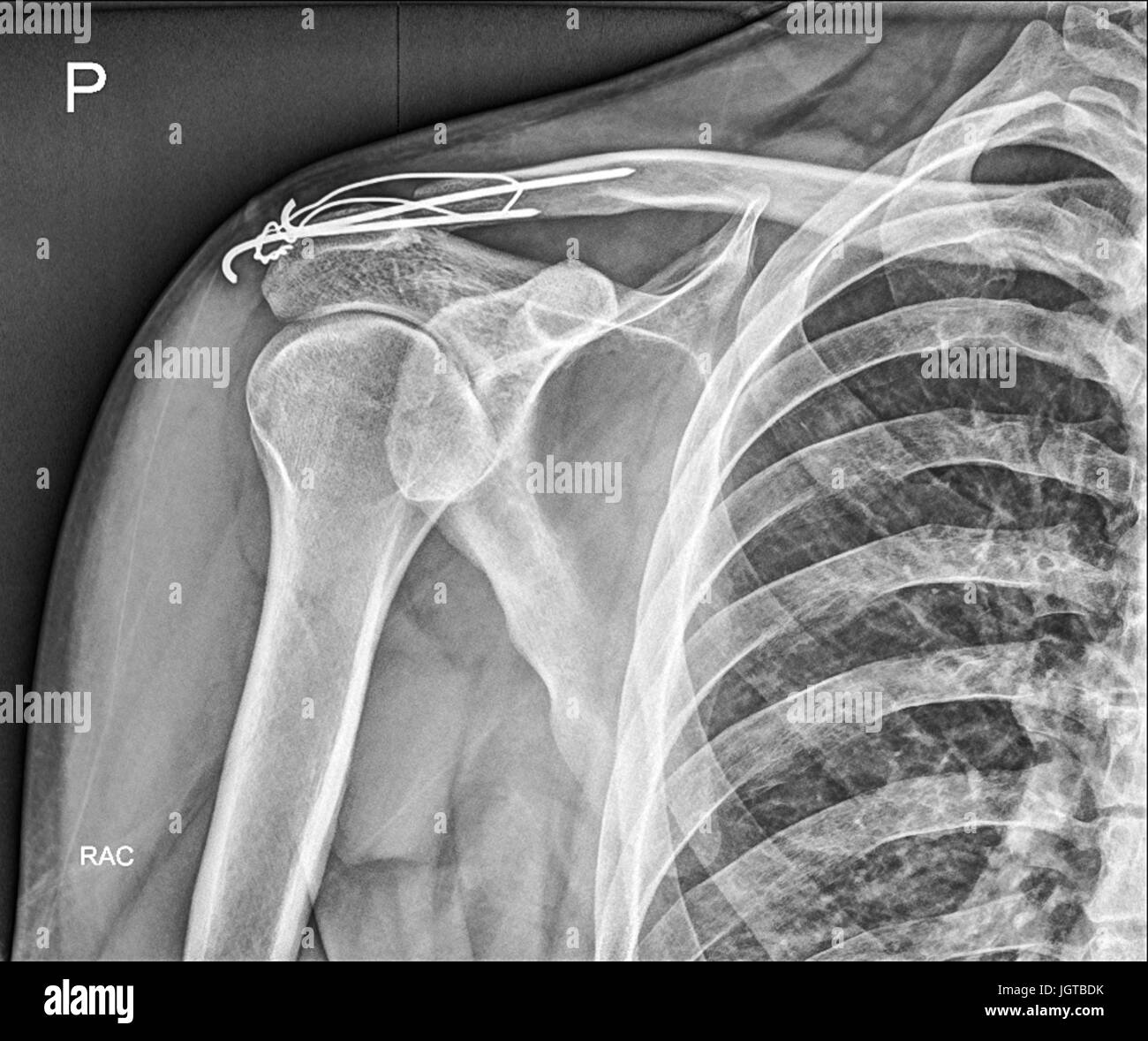 Broken clavicle bone, Shoulder Medical Xray, Patient treatment Stock