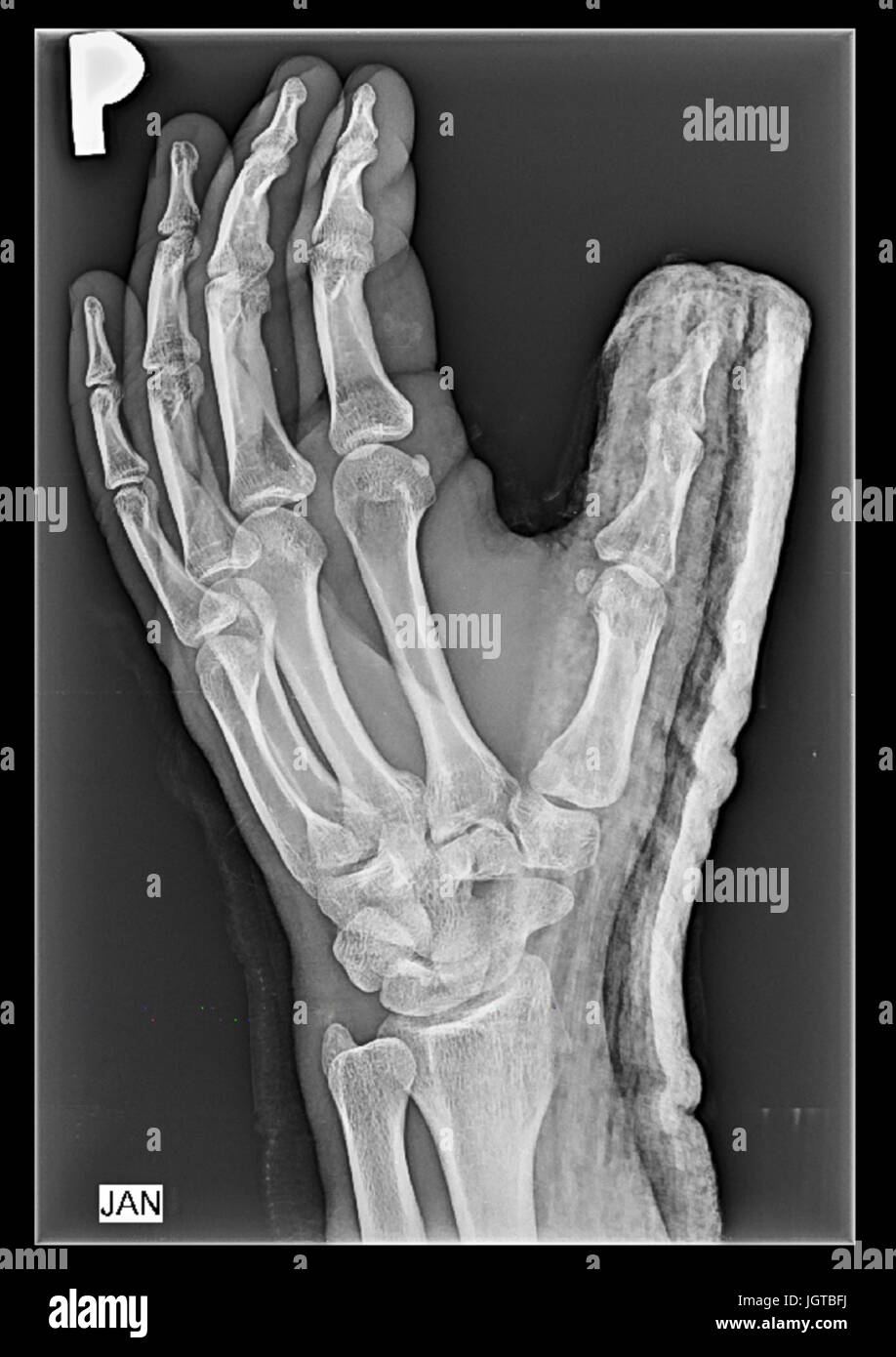 Orthopedic cast on a patients hand, fixating thumb, fingers joints Stock Photo