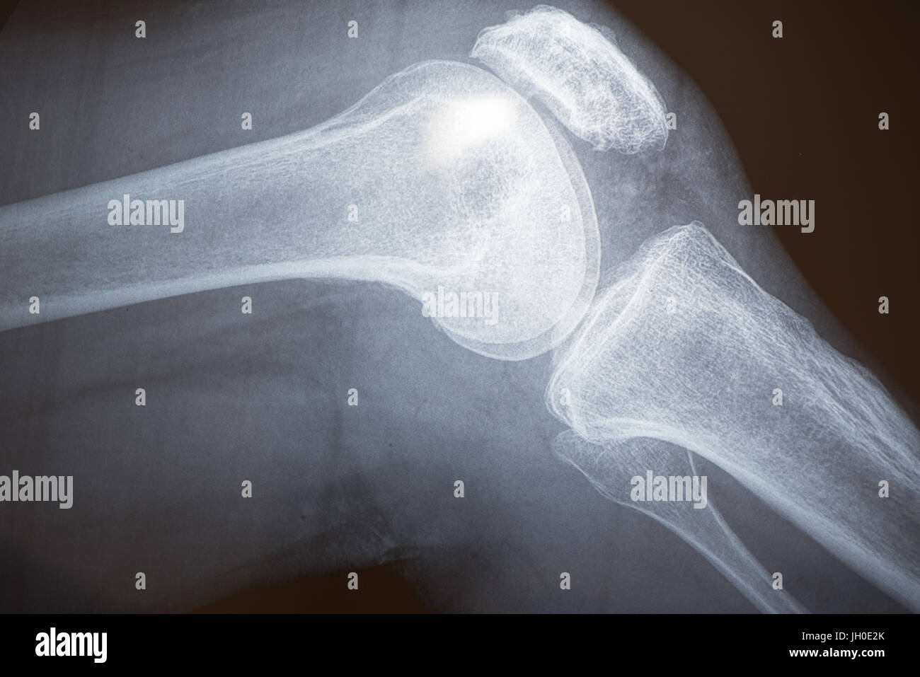 Xray image of knee bones Stock Photo - Alamy
