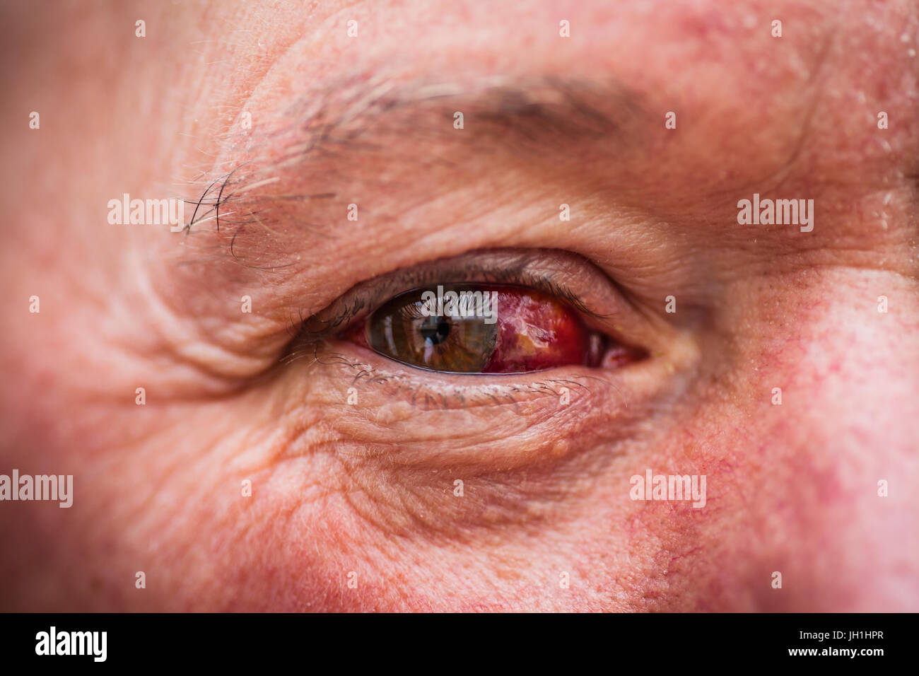 Older male with bloodshot eye Stock Photo