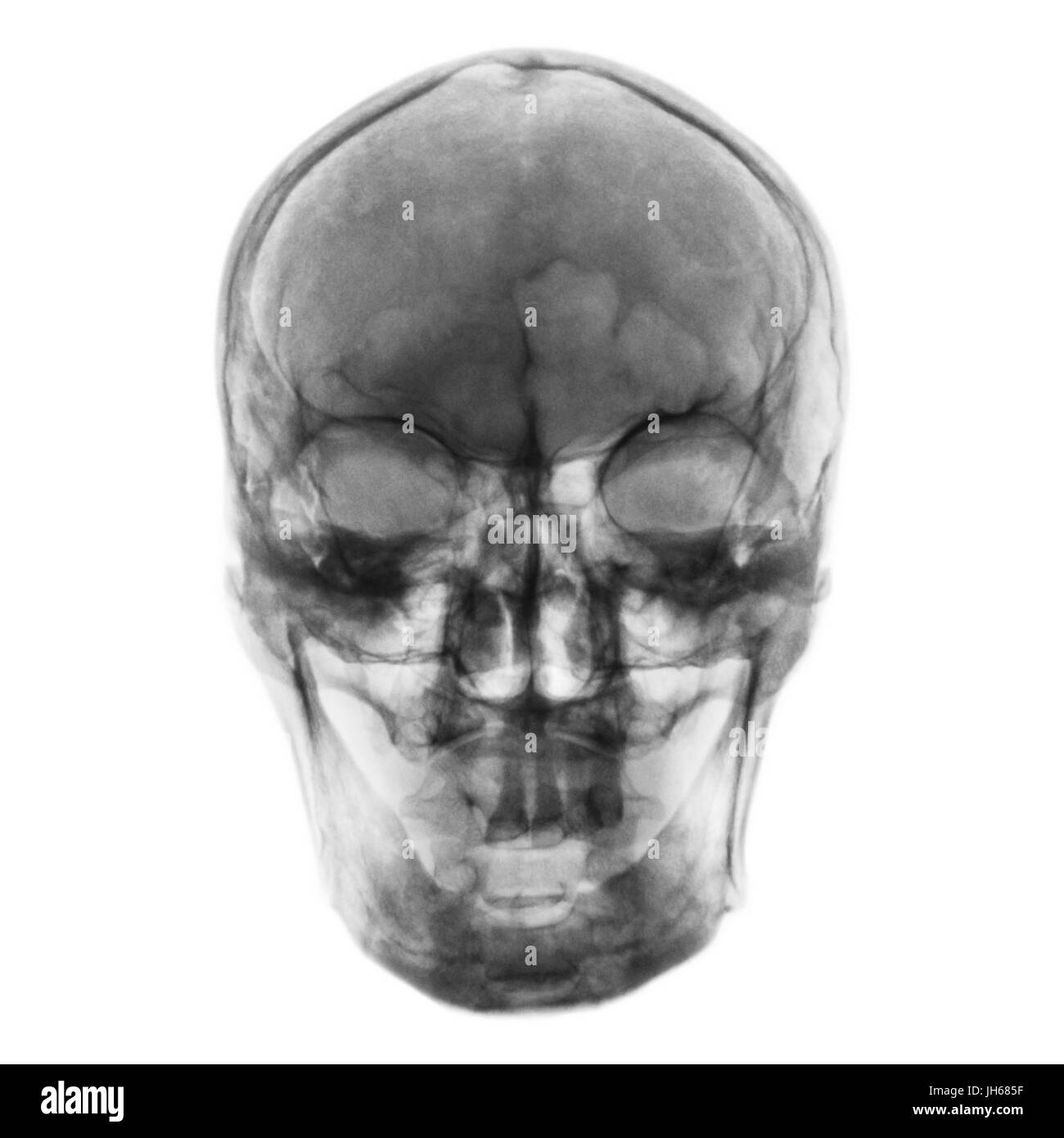 Film x-ray of normal human skull . front view . Stock Photo