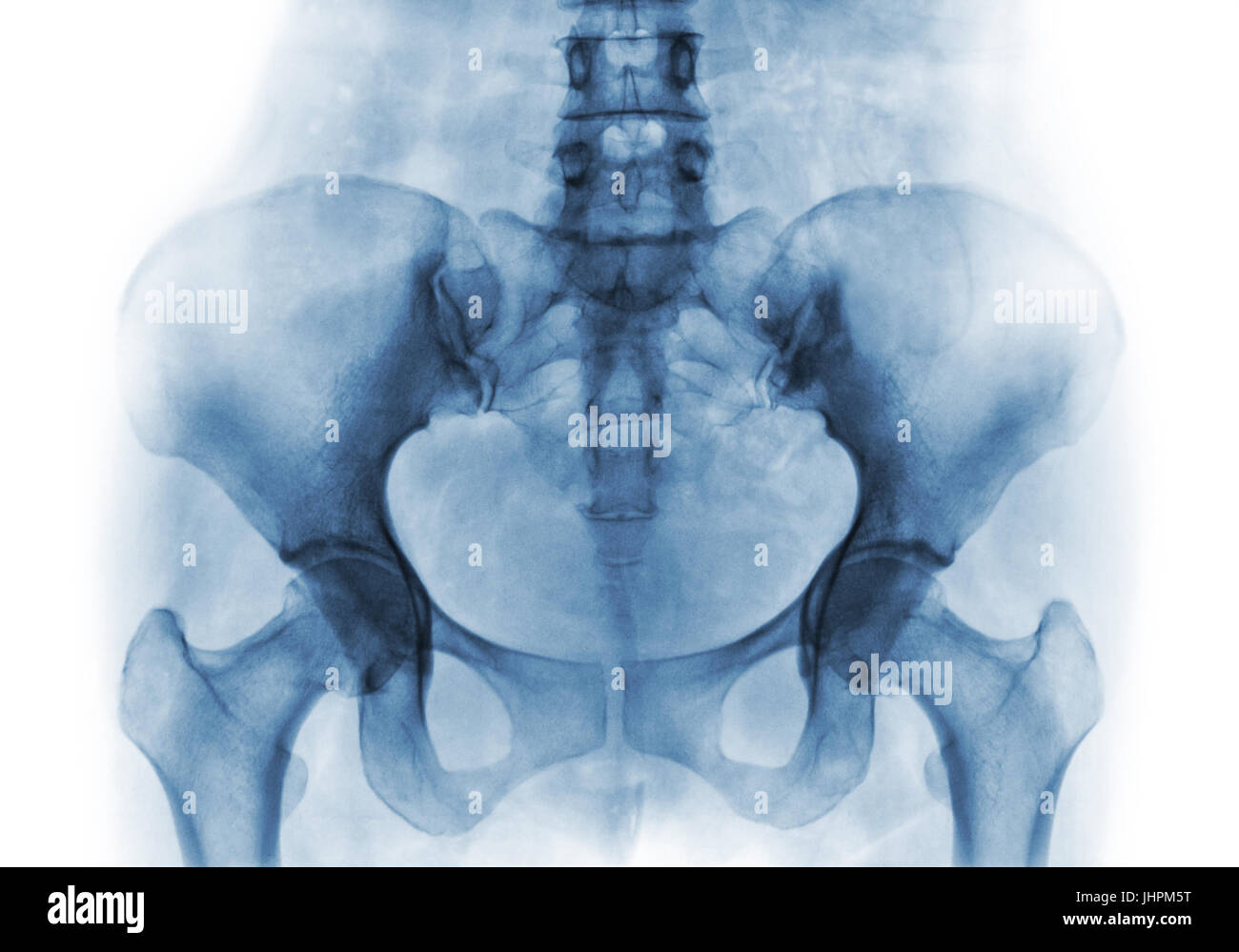 Film x-ray of normal human pelvis and hip joints . Stock Photo