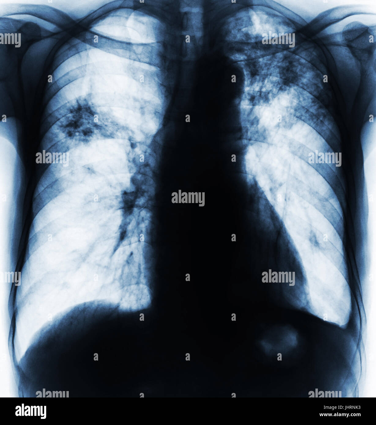 Pulmonary Tuberculosis . Film chest xray show fibrosis , interstitial infiltration both lung