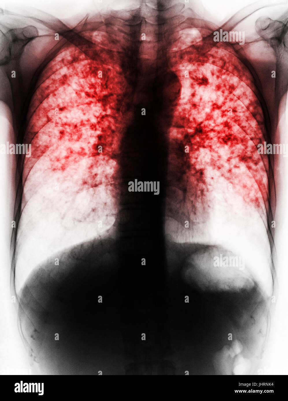 Pulmonary Tuberculosis . Film chest xray show fibrosis , interstitial