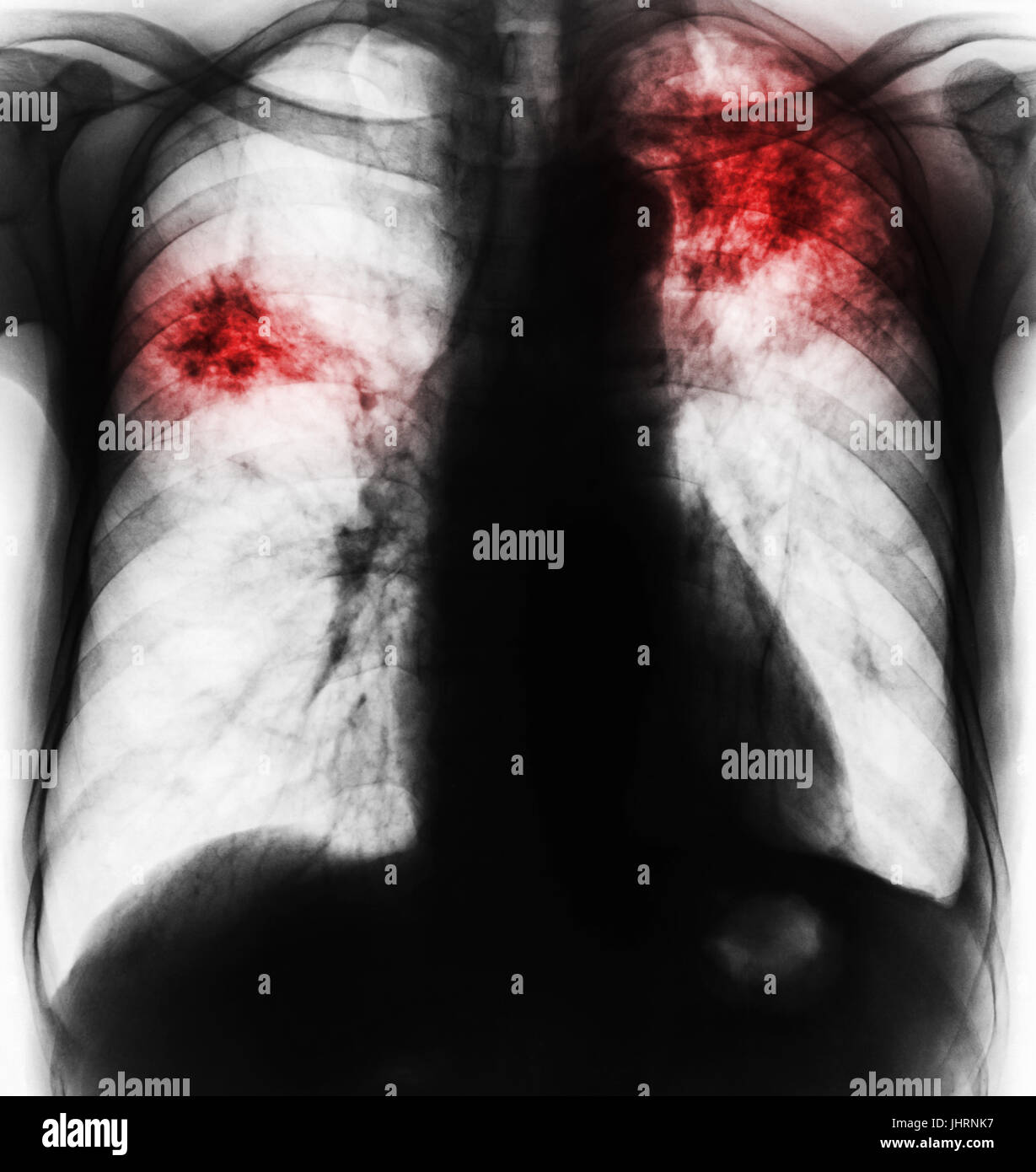 Pulmonary Tuberculosis Film Chest X Ray Show Fibrosis vrogue.co
