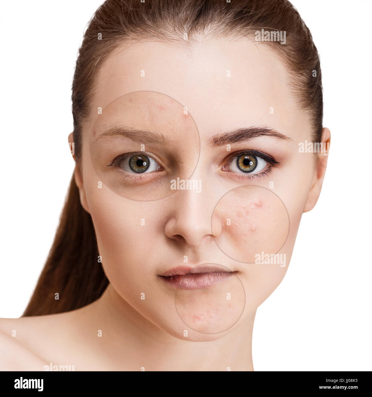 Circles shows problem skin of young girl Stock Photo