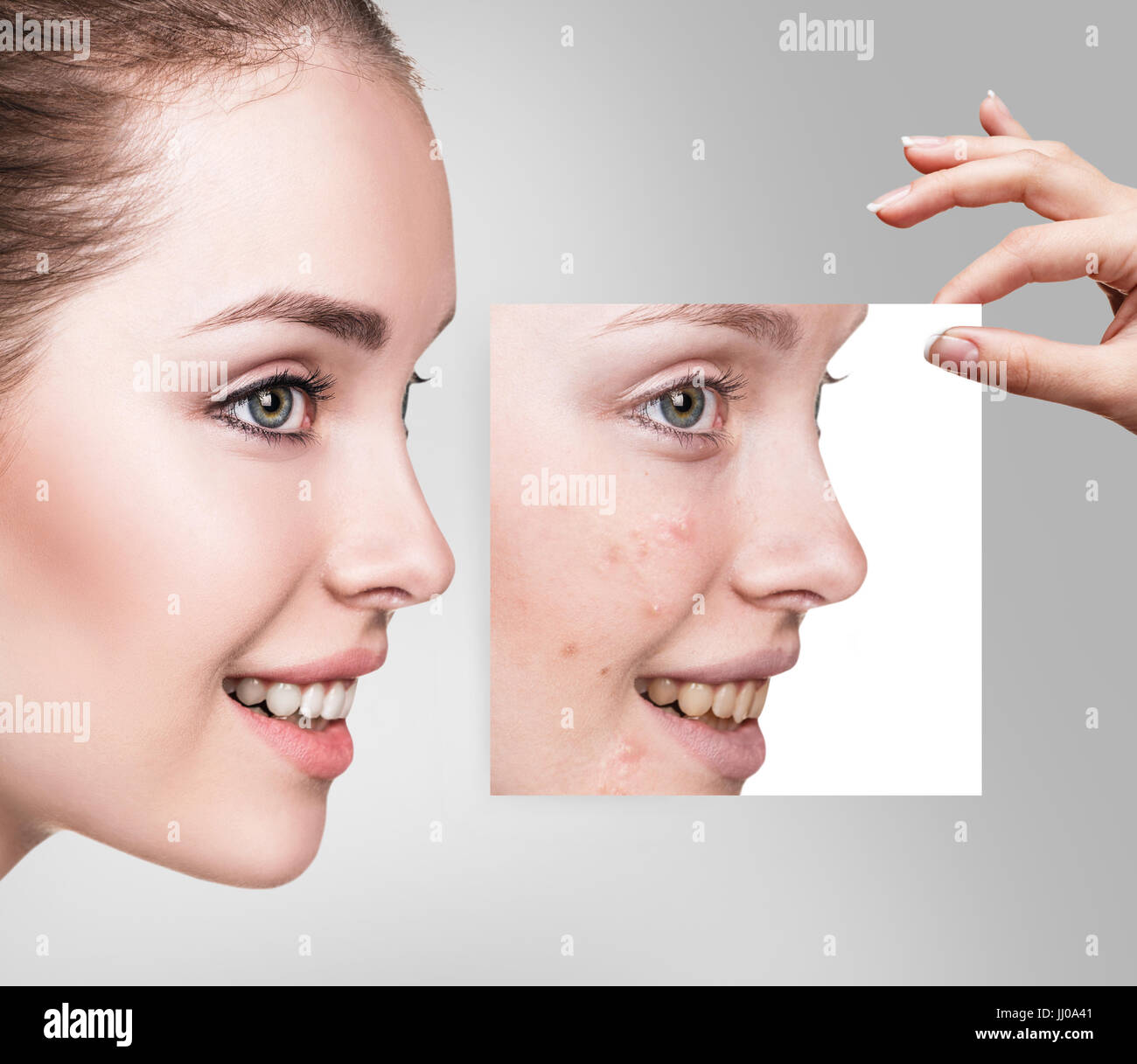 Woman shows photo with bad skin before treatment. Stock Photo