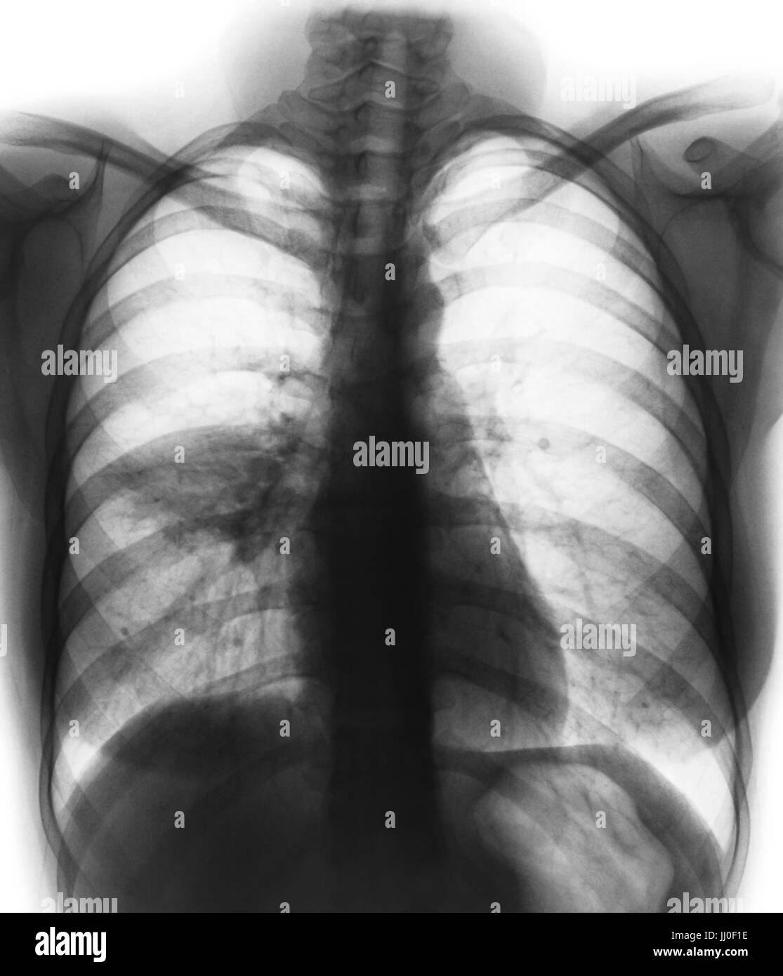 Pneumonia ( film chest x-ray show alveolar infiltrate at right middle lung ) ( image for pulmonary tuberculosis . Mers-CoV . SARS ) Stock Photo