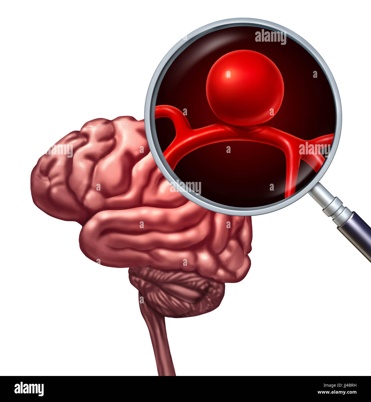 Brain aneurysm or cerebral aneurysms medical disorder concept as a magnification of a human thinking organ with a blood vessel. Stock Photo