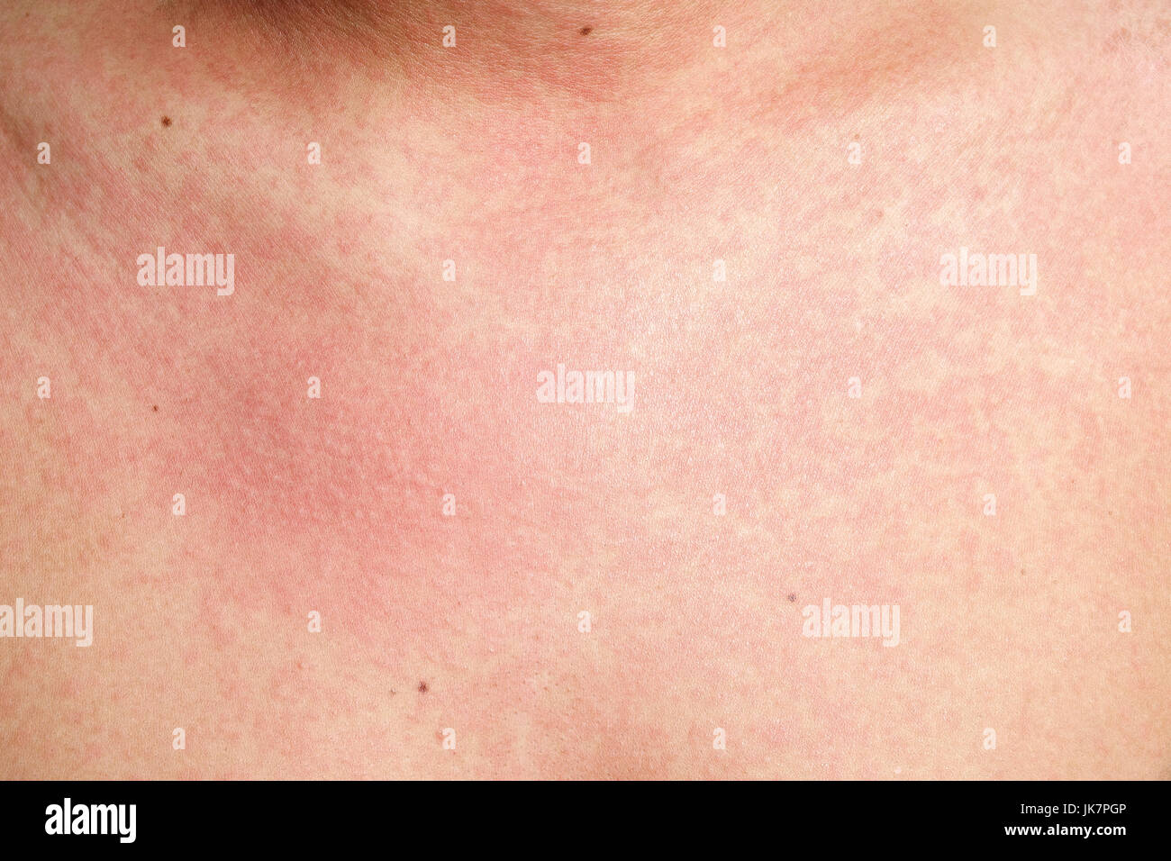 Man with dermatitis problem of rash ,Allergy rash Stock Photo