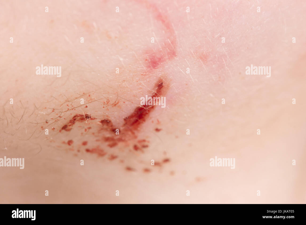 Bleeding fresh wound on a person skin closeup Stock Photo