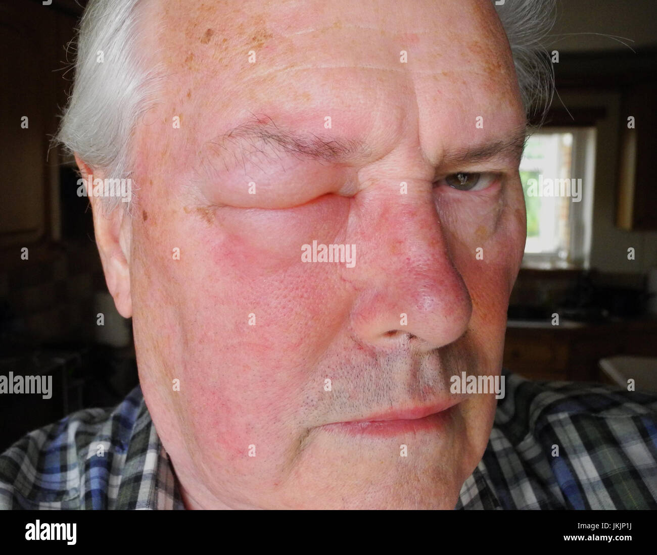 The image shows an allergic reaction to a wasp, bee, hornet, insect sting.  The reaction to a venomous sting can range from mild to fatal.  This image does NOT require a model release as the subject is the photographer. The sting was from a so-called social wasp - the photographer considers that the action was not very sociable ! Stock Photo
