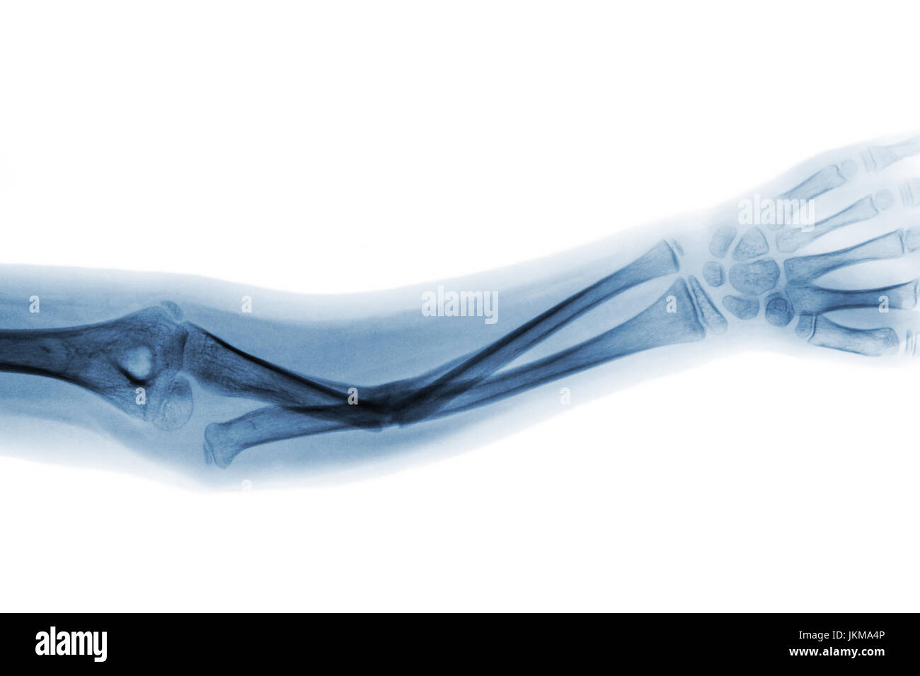 Film xray forearm AP show fracture shaft of ulnar bone Stock Photo Alamy