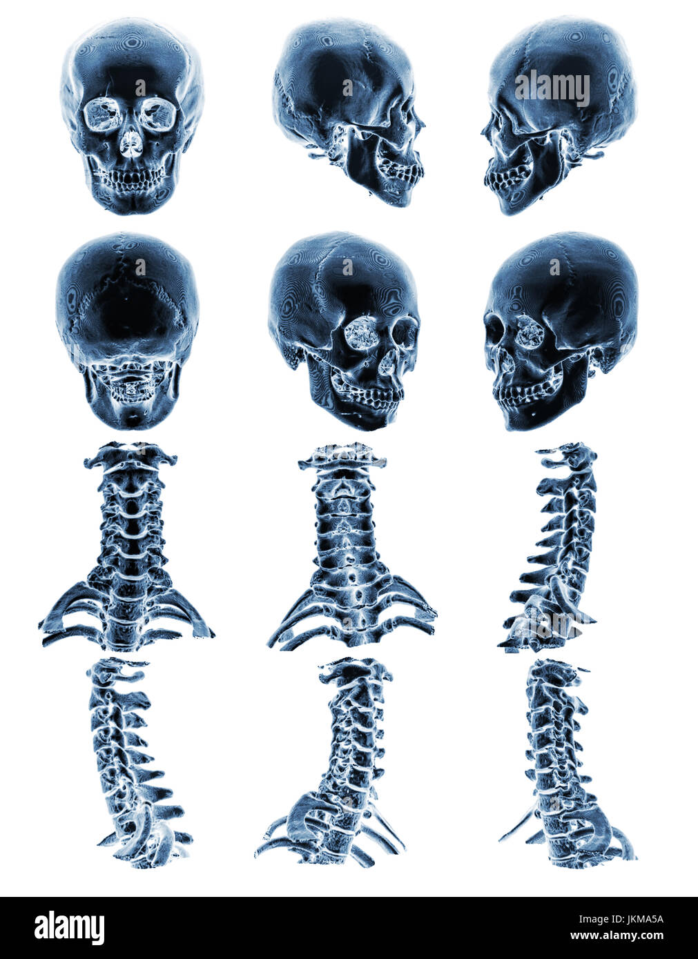 CT scan ( Computed tomography ) with 3D graphic show normal human skull and cervical spine . Multiple view . Stock Photo