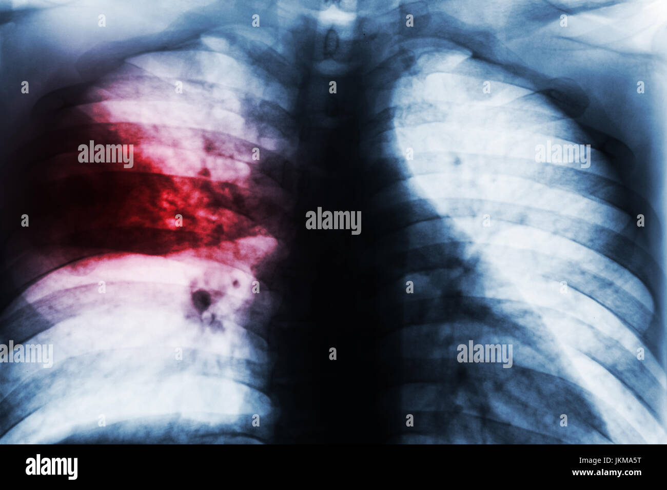 Lobar Pneumonia . Film chest xray show patchy infiltrate at right