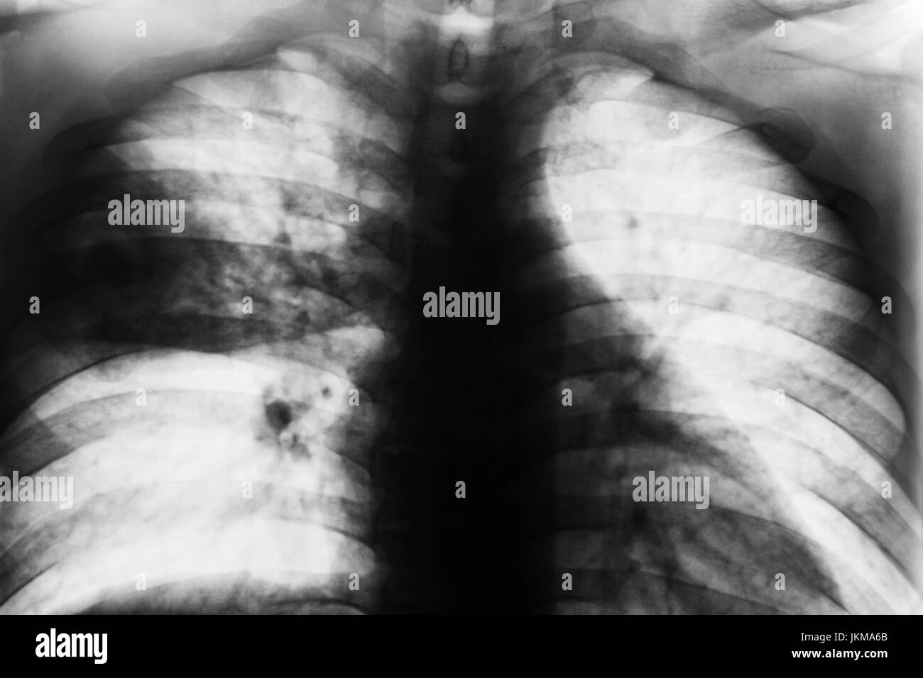 Lobar Pneumonia . Film chest x-ray show patchy infiltrate at right middle lung from Mycobacterium tuberculosis infection ( Pulmonary tuberculosis ) . Stock Photo