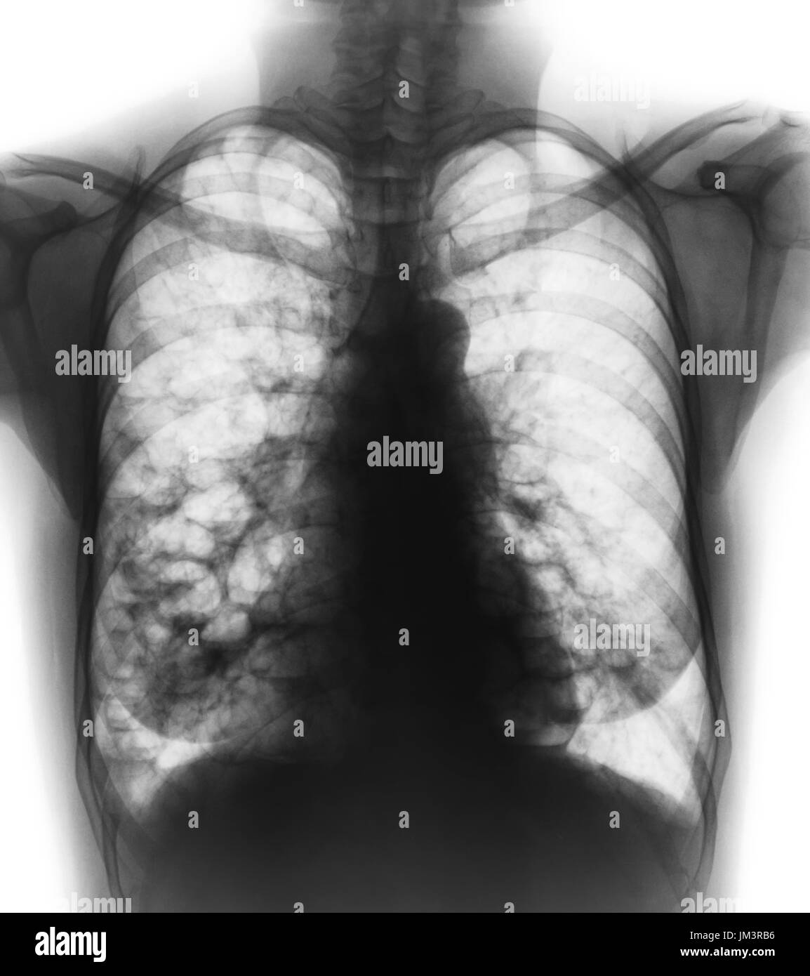 Bronchiectasis .  X-ray chest show multiple lung bleb and cyst due to chronic infection . Front view . Stock Photo