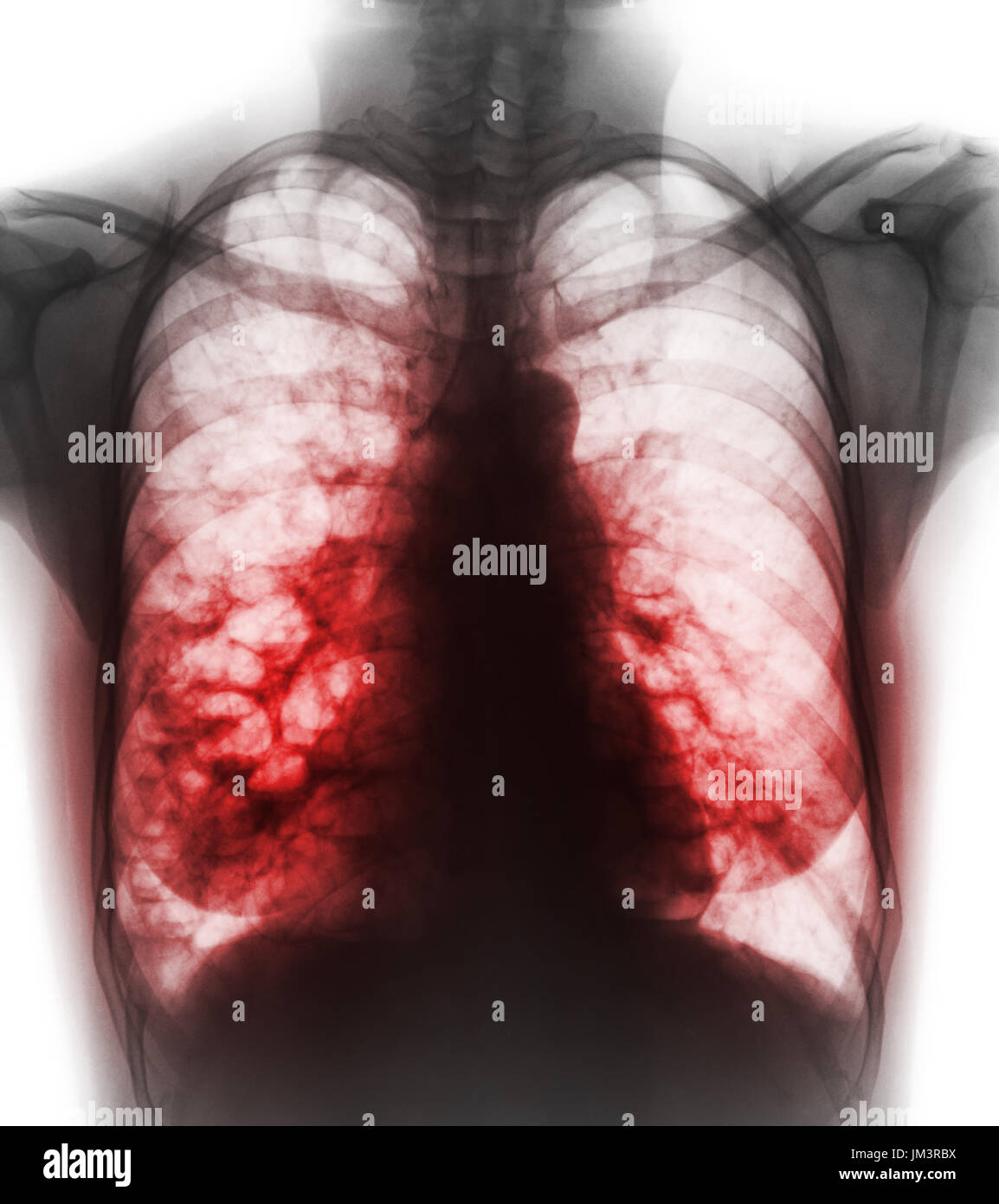 Bronchiectasis .  X-ray chest show multiple lung bleb and cyst due to chronic infection . Front view . Stock Photo