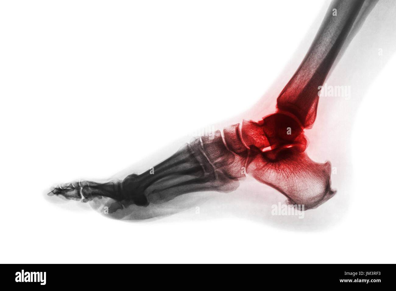 Arthritis of ankle . X-ray of foot . Lateral view . Invert color style . Gout or Rheumatoid concept . Stock Photo