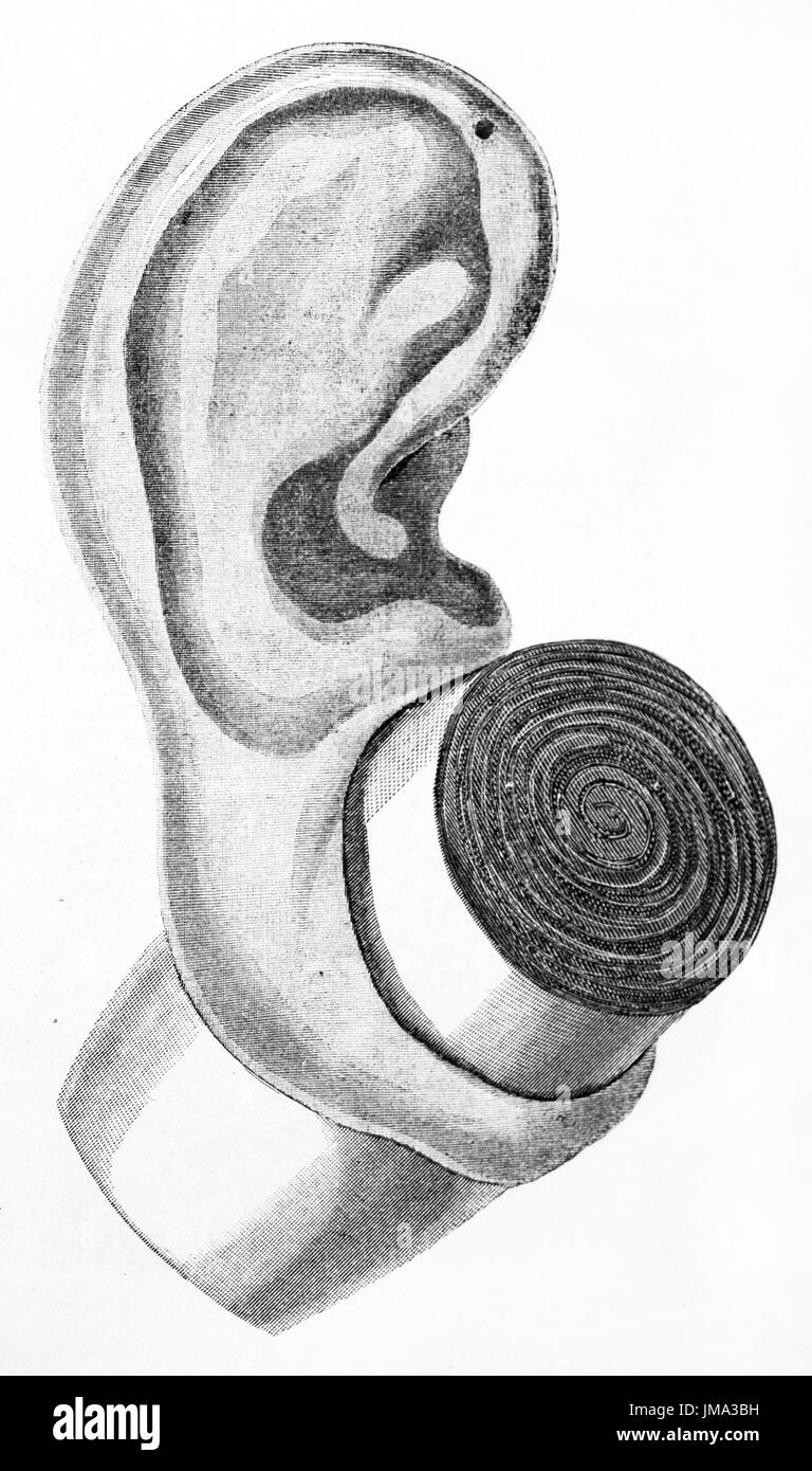 Old illustration of ear of Lengua people (Granc Chaco natives, Paraguay), pierced by wood. By unidentified author, published on Le Tour du Monde, Pari Stock Photo