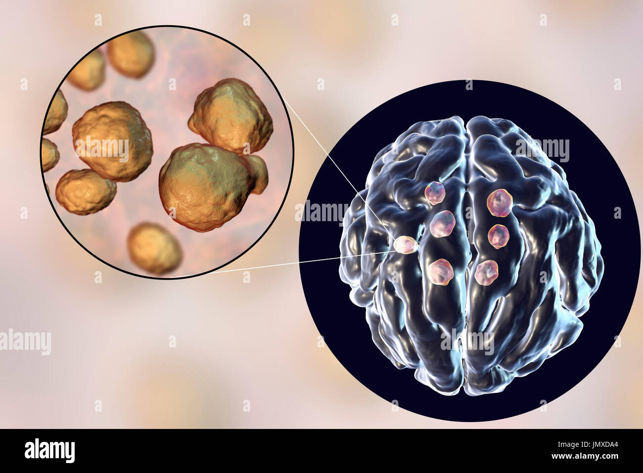 Cryptococcal brain lesions. Illustration of multiple brain parenchyma lesions caused by the fungus Cryptococcus neoformans and a close-up view of the fungus. C. neoformans is a yeast-like organism. Cryptococcosis is a rare infection that affects people with a deficient immune system such as in AIDS (acquired immunodeficiency syndrome). It is caused by inhaling the fungus found in soil contaminated by pigeon droppings. Infection may cause meningitis, or single or multiple lesions in brain parenchyma. Cryptococcus neoformans var. gattii more commonly produces parenchyma lesions while Stock Photo