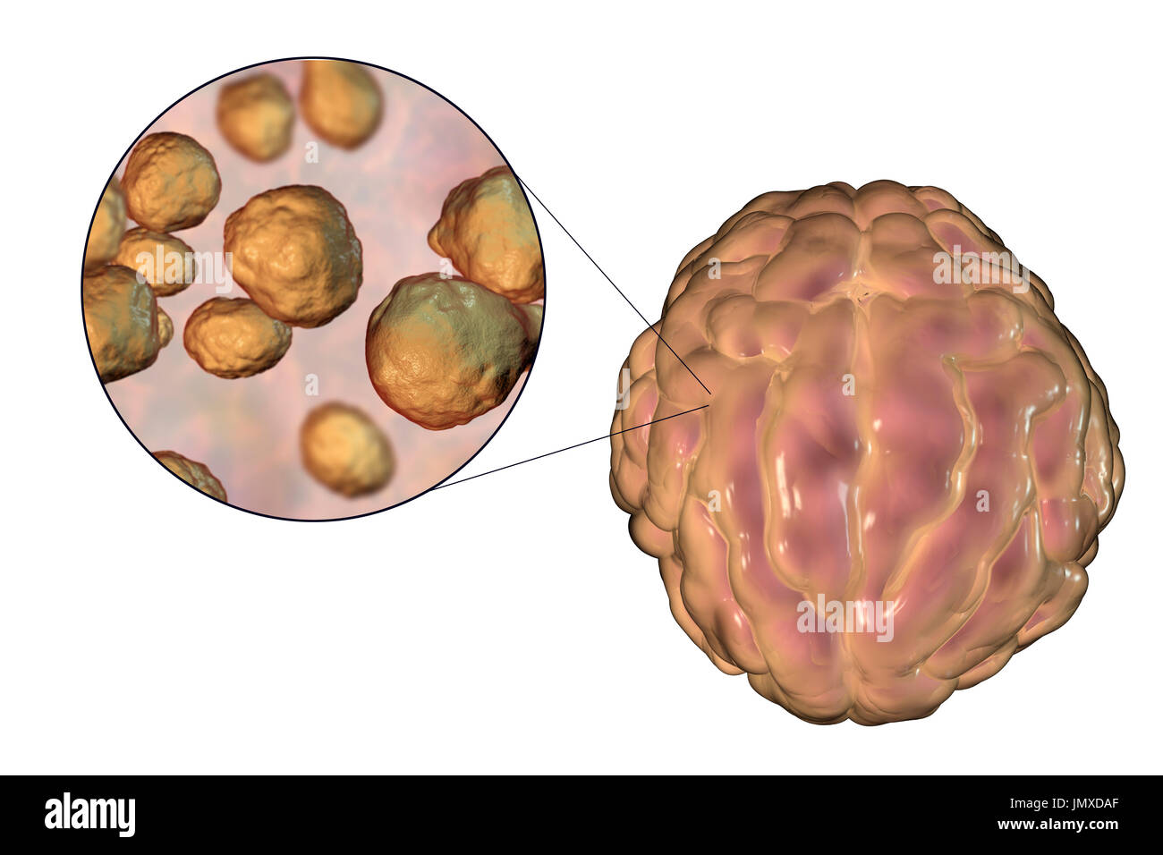 Meningitis caused by the fungus Cryptococcus, computer illustration. Cryptococcus neoformans is the common cause of meningitis in HIV-infected patients. The illustration shows swelling of meninges and close-up view of C. neoformans. Stock Photo