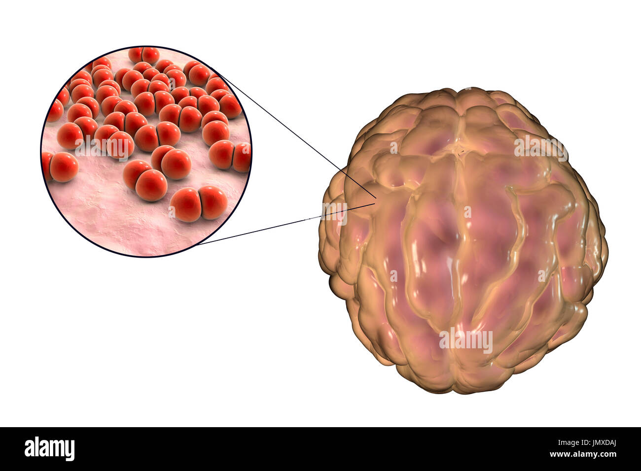 Meningitis caused by the bacterium Streptococcus pneumoniae, computer illustration. The illustration shows swelling of meninges and close-up view of bacteria S. pneumoniae. Stock Photo