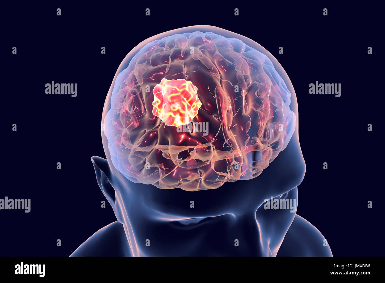 Brain cancer, computer artwork Stock Photo - Alamy