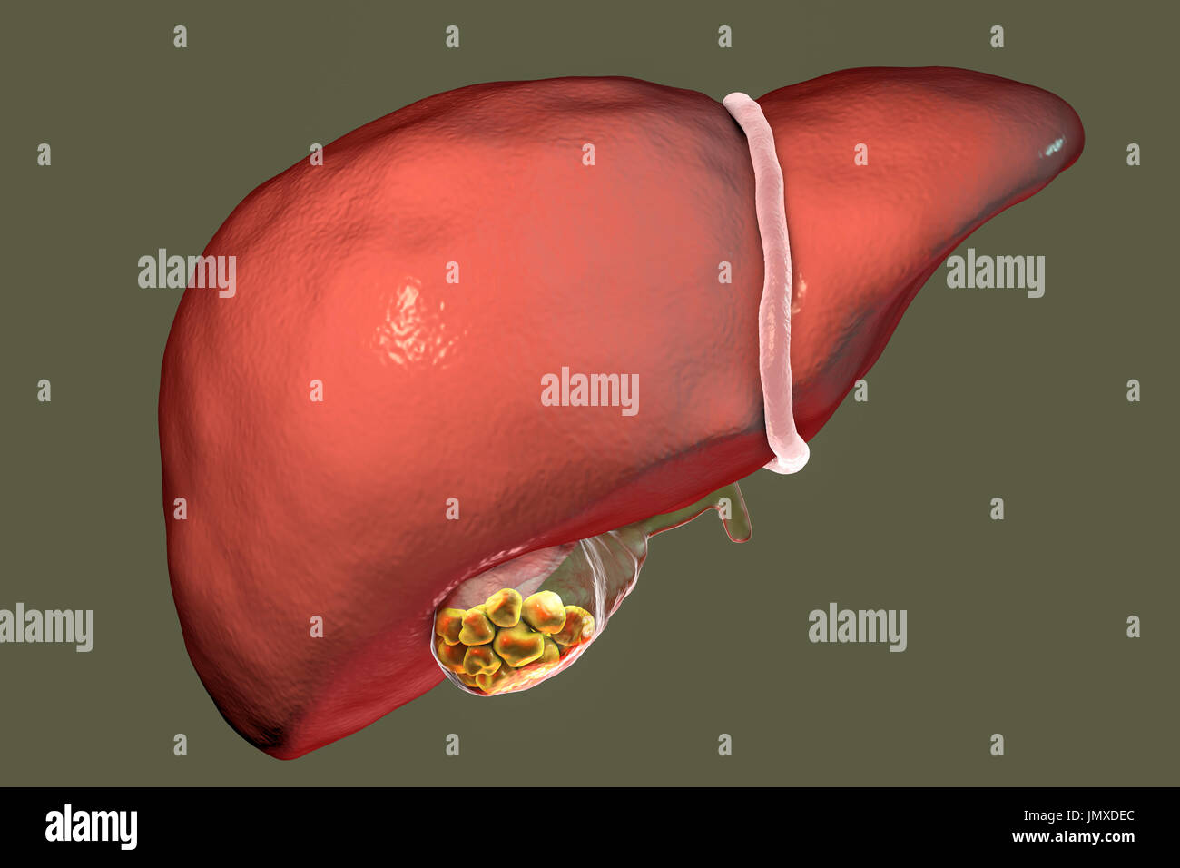 Gallstones. Illustration showing the liver and gallbladder with gallstones. The gallbladder stores bile, the digestive fluid that is produced by the liver (above gallbladder) and passed to the small intestine. Gallstones, hard deposits formed of cholesterol and bile salts, form in the gallbladder when there is an imbalance in the chemical composition of the bile. Gallstones are usually symptomless, unless one obstructs the bile duct, causing acute pain, jaundice and infection. Treatment is with drugs to dissolve the stones or surgical removal of the gallbladder. Stock Photo