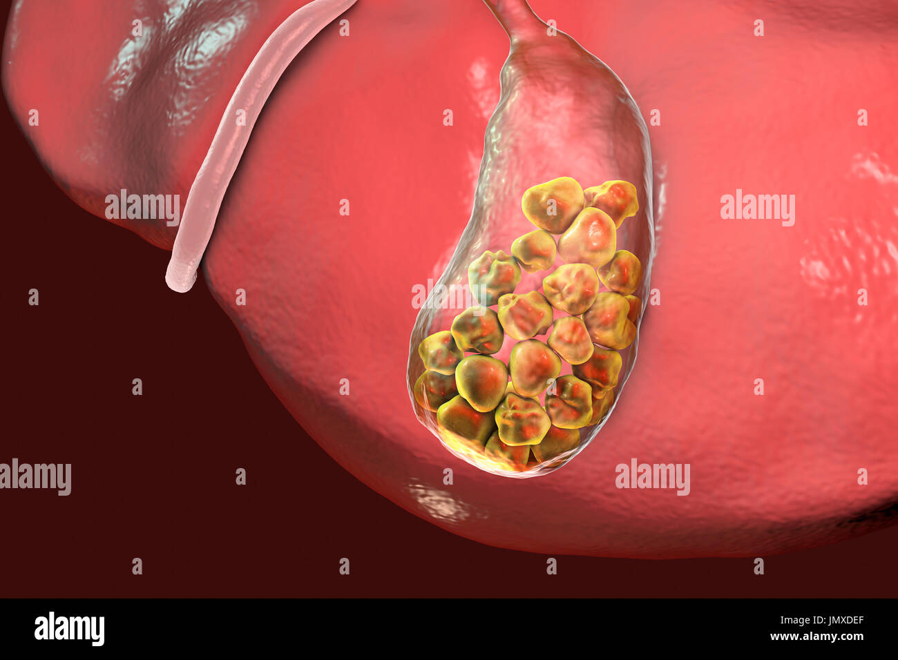 Gallstones. Illustration showing the liver and gallbladder with gallstones. The gallbladder stores bile, the digestive fluid that is produced by the liver (above gallbladder) and passed to the small intestine. Gallstones, hard deposits formed of cholesterol and bile salts, form in the gallbladder when there is an imbalance in the chemical composition of the bile. Gallstones are usually symptomless, unless one obstructs the bile duct, causing acute pain, jaundice and infection. Treatment is with drugs to dissolve the stones or surgical removal of the gallbladder. Stock Photo