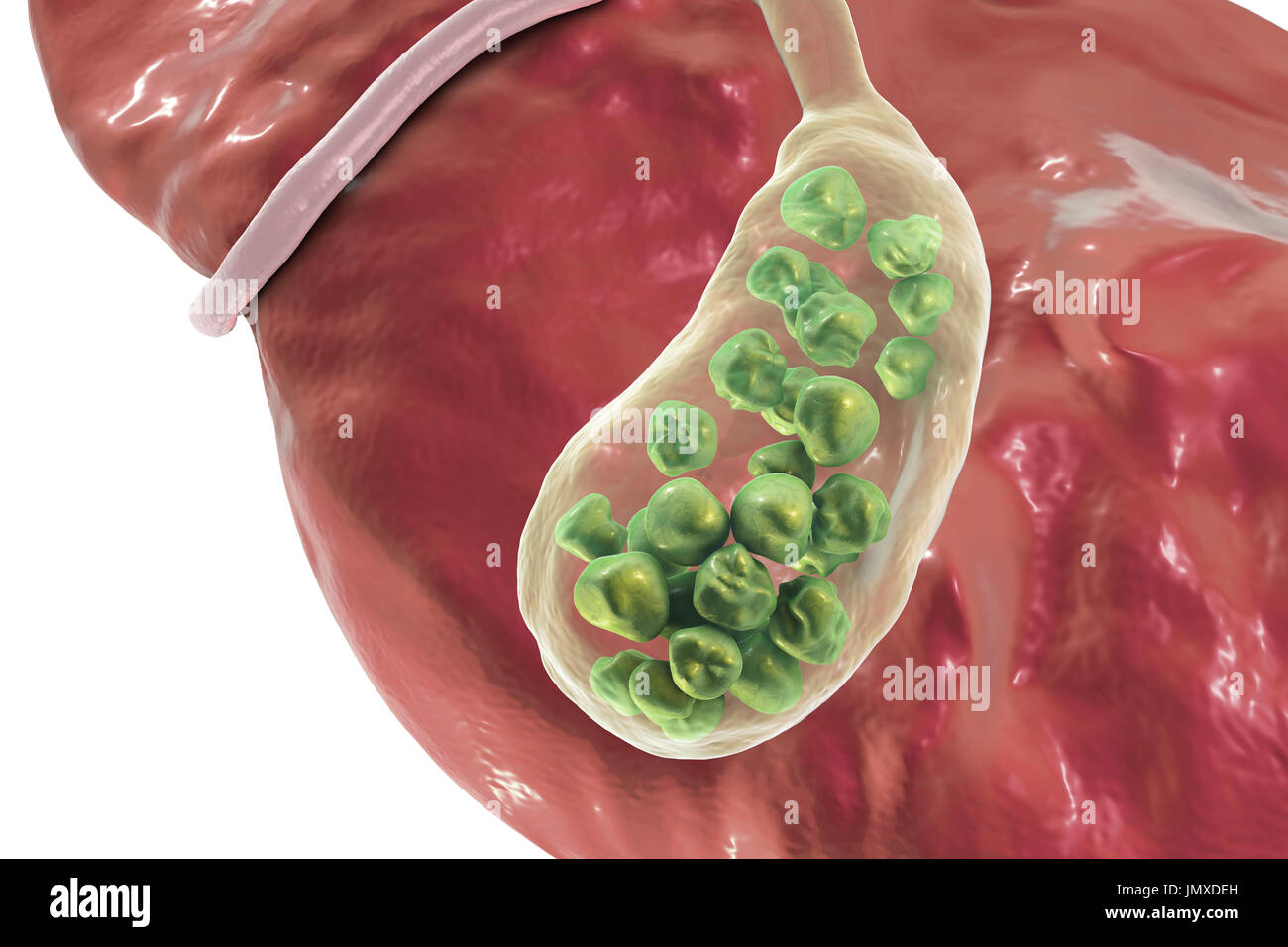 Gallstones. Illustration showing the liver and gallbladder with gallstones. The gallbladder stores bile, the digestive fluid that is produced by the liver (above gallbladder) and passed to the small intestine. Gallstones, hard deposits formed of cholesterol and bile salts, form in the gallbladder when there is an imbalance in the chemical composition of the bile. Gallstones are usually symptomless, unless one obstructs the bile duct, causing acute pain, jaundice and infection. Treatment is with drugs to dissolve the stones or surgical removal of the gallbladder. Stock Photo