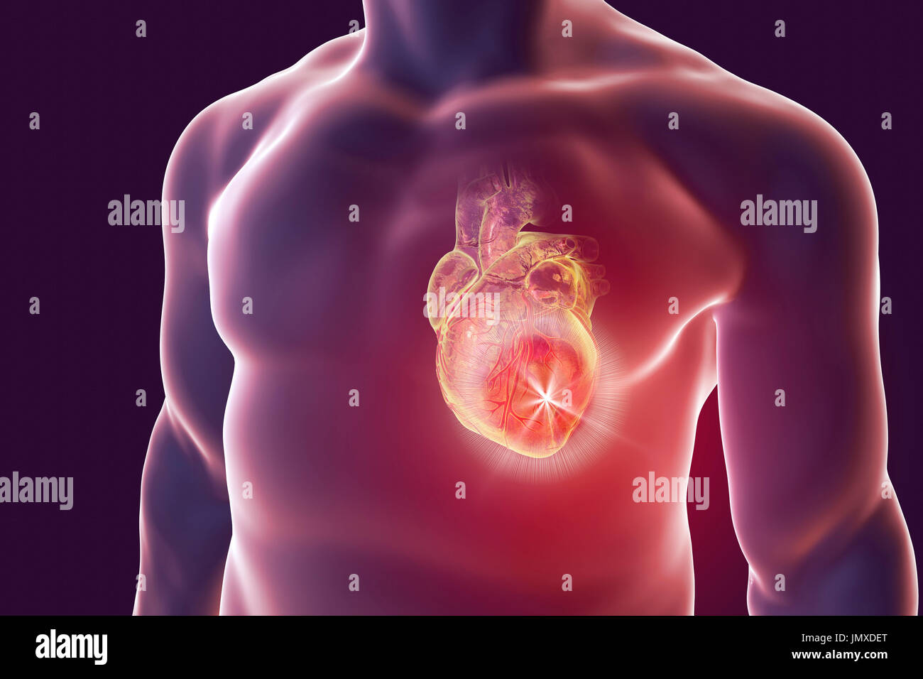 Heart attack, conceptual computer illustration. Stock Photo