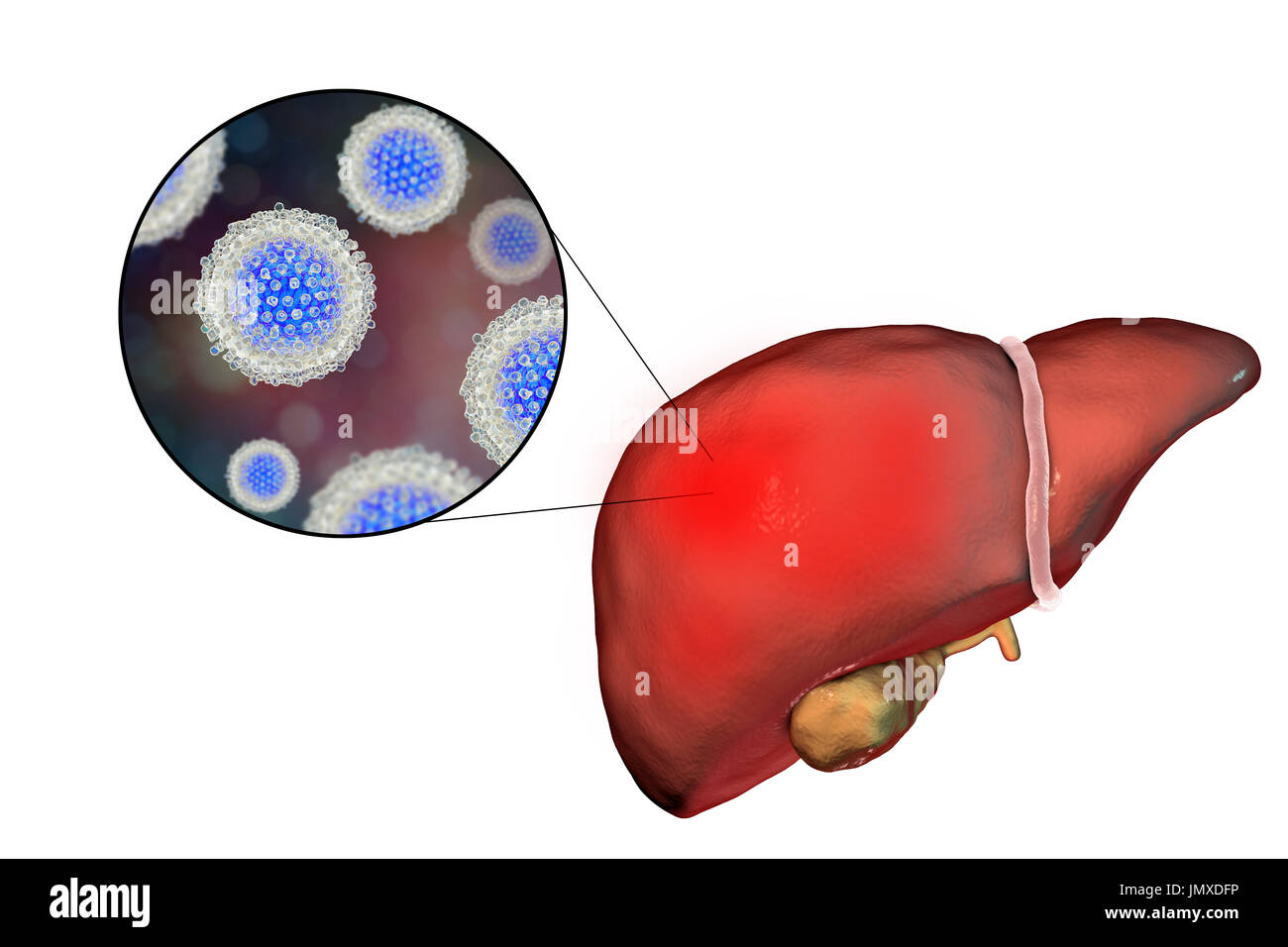 Liver with hepatitis and close-up view of hepatitis C viruses, illustration. Stock Photo