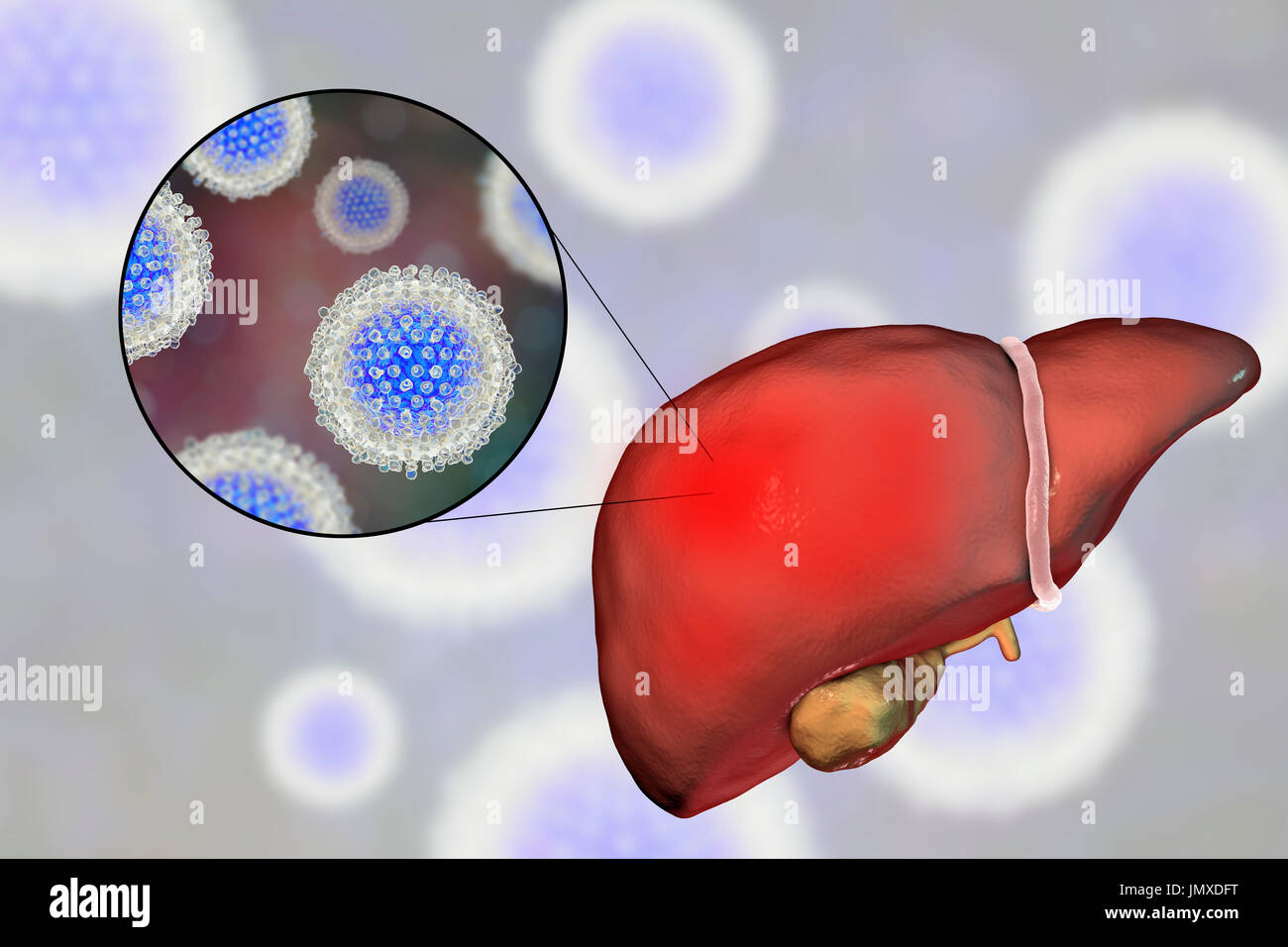 Liver with hepatitis and close-up view of hepatitis C viruses, illustration. Stock Photo