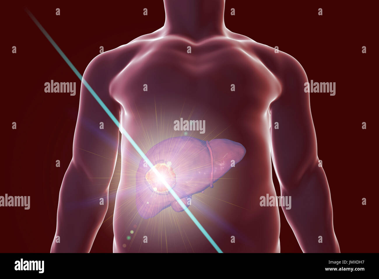 Liver cancer treatment, conceptual image Stock Photo Alamy