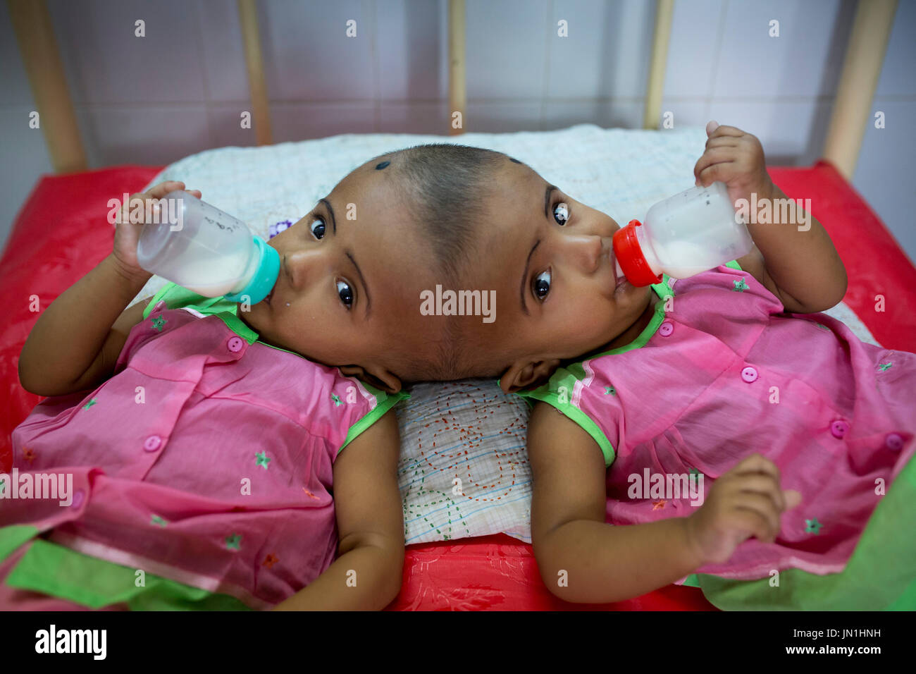 Dhaka, Bangladesh. 29th July, 2017. DHAKA, BANGLADESH - JULY 29 : Conjoined twin girls Rabeya Islam and Rokeya Islam drinking milk at a hospital in Dhaka, Bangladesh on July 29, 2017. Taslima Khatun, a school teacher, gave a birth of the conjoined headed twins on 16 July 2016 after a cesarean. The twins have been admitted at a government hospital for examination before potentially surgery to separate their heads. Credit: zakir hossain chowdhury zakir/Alamy Live News Stock Photo
