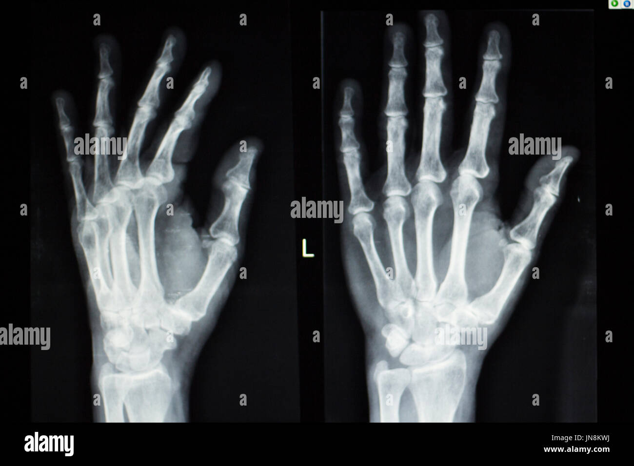 Hand fingers joint xray test scan results of patient with arthritis and