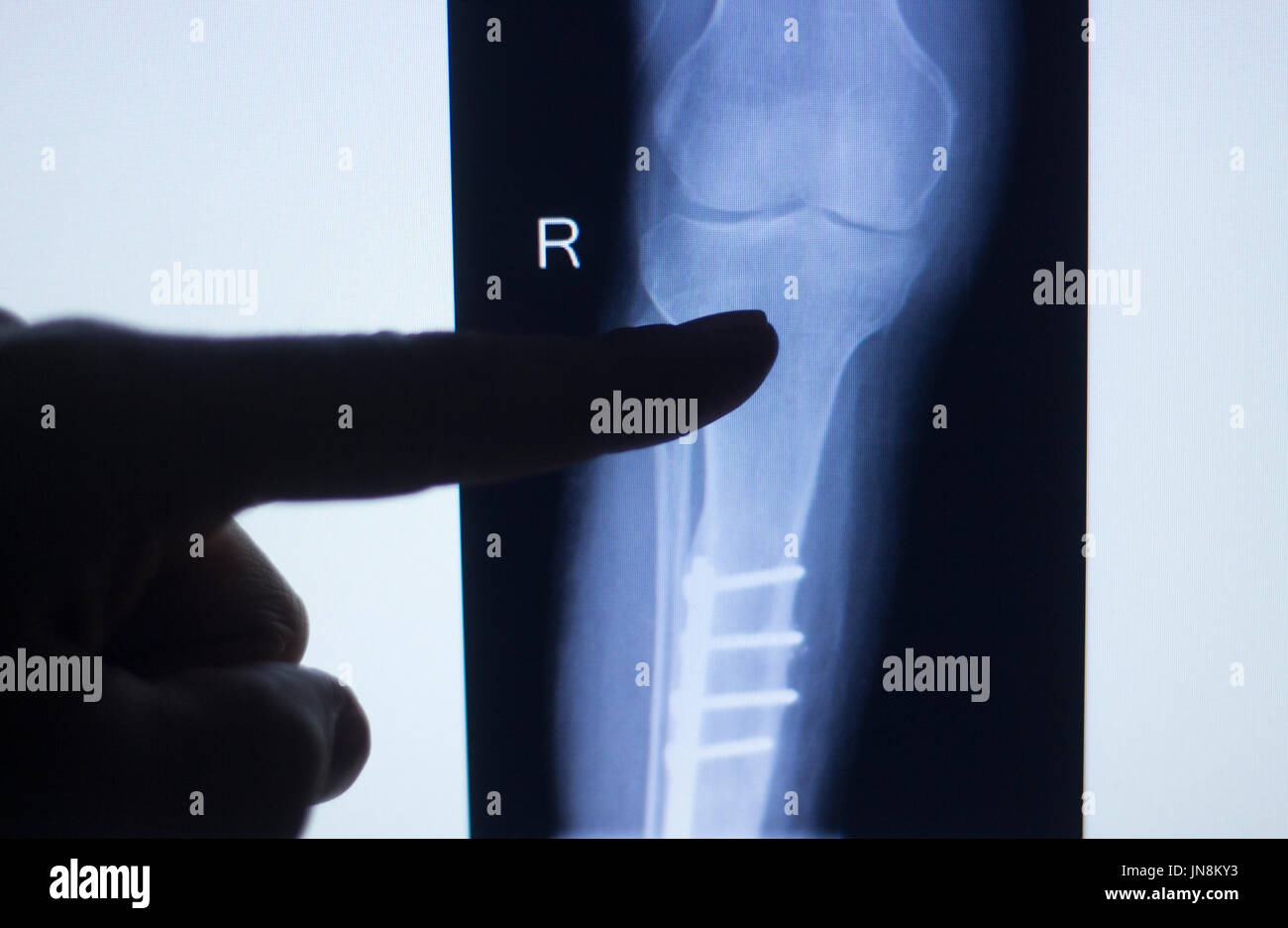 Knee joint xray test scan results of patient with arthritis and joints