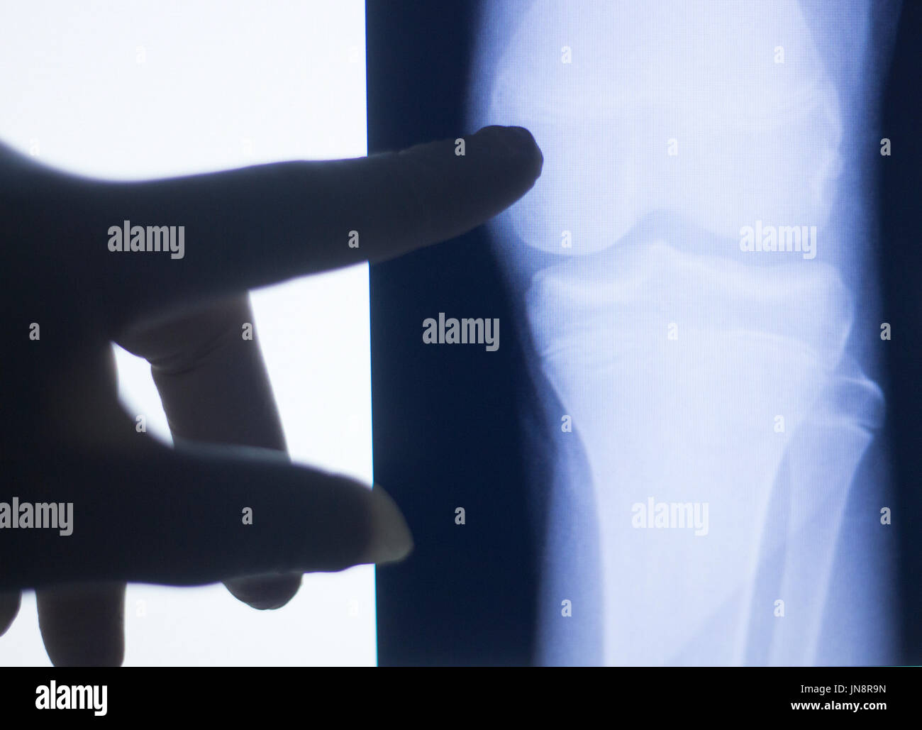 Knee joint xray test scan results of patient with arthritis and joints