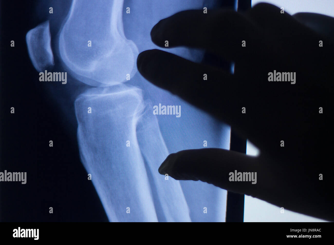 Knee joint xray test scan results of patient with arthritis and joints