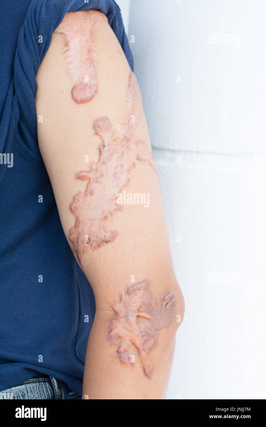 Keloid hires stock photography and images Alamy