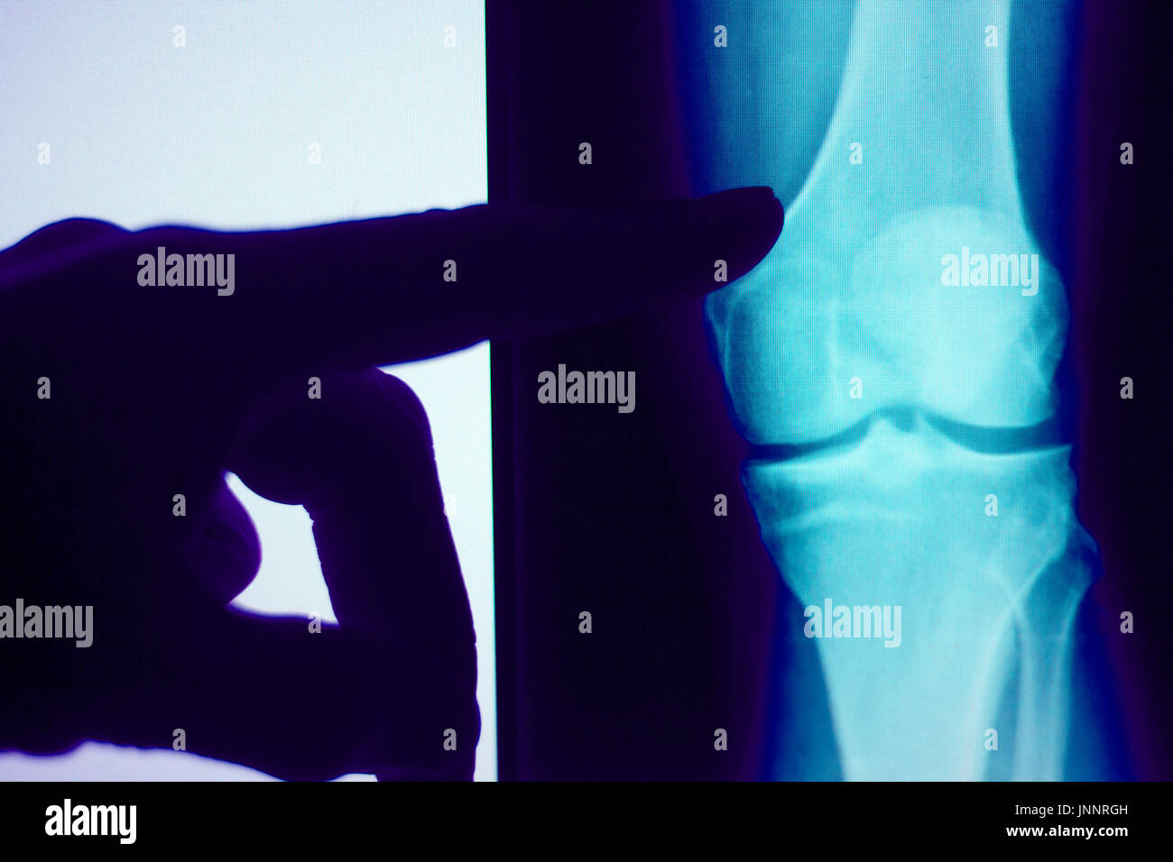 Knee joint xray test scan results of patient with arthritis and joints
