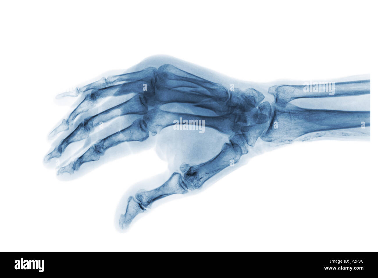 Fracture at 3rd and 4th metacarpal bone . Film x-ray of adult hands . Oblique view . Stock Photo