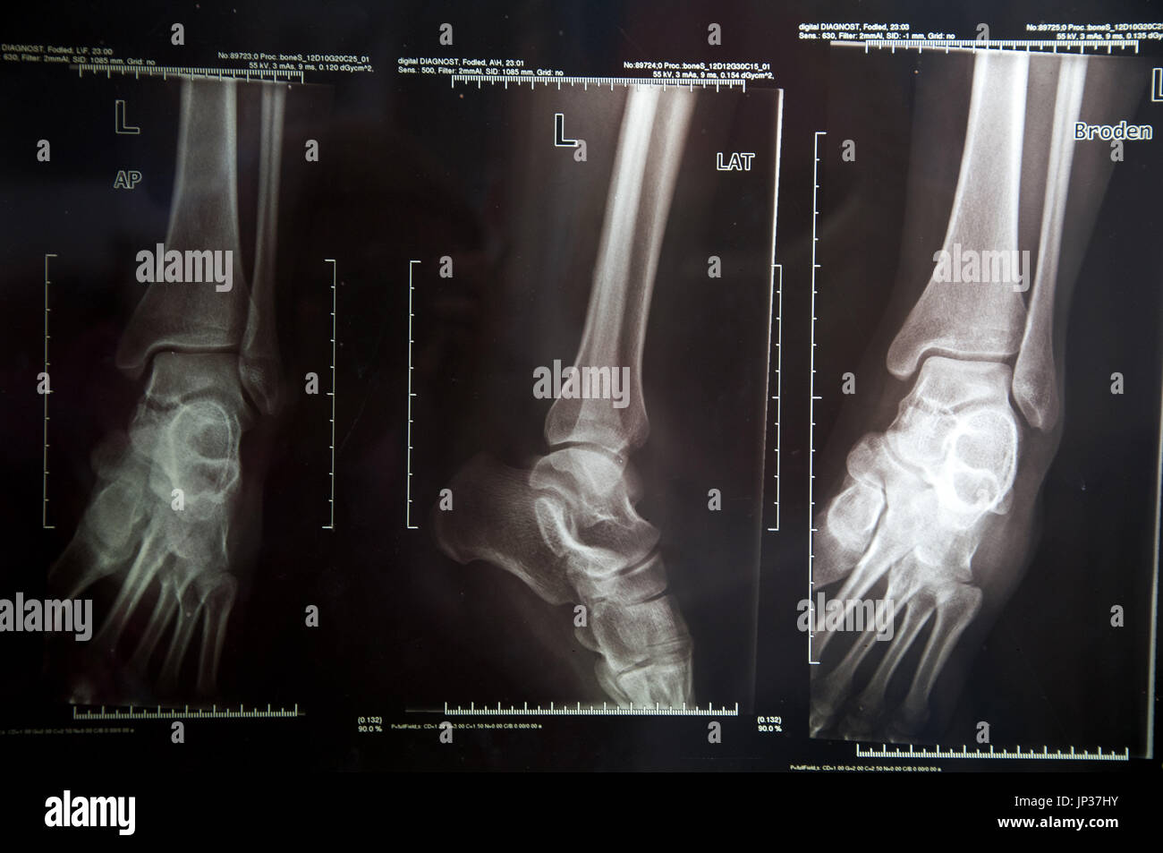 Xray image of human leg Stock Photo