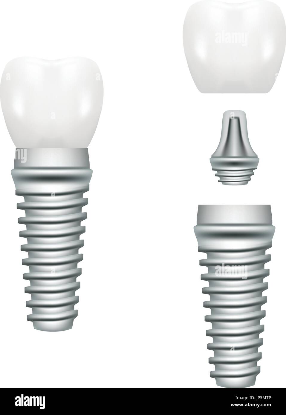 Realistic Dental Implant Structure With All Parts Crown, Abutment