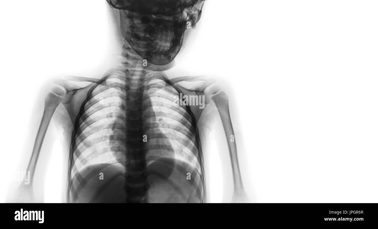 Film x-ray upper half body of child and blank area at right side . Stock Photo