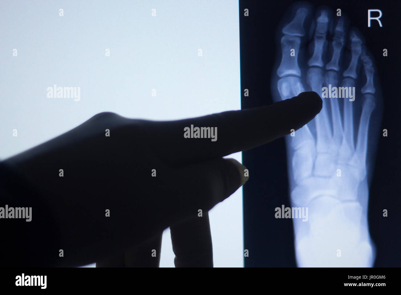 Foot toes joint xray test scan results of patient with