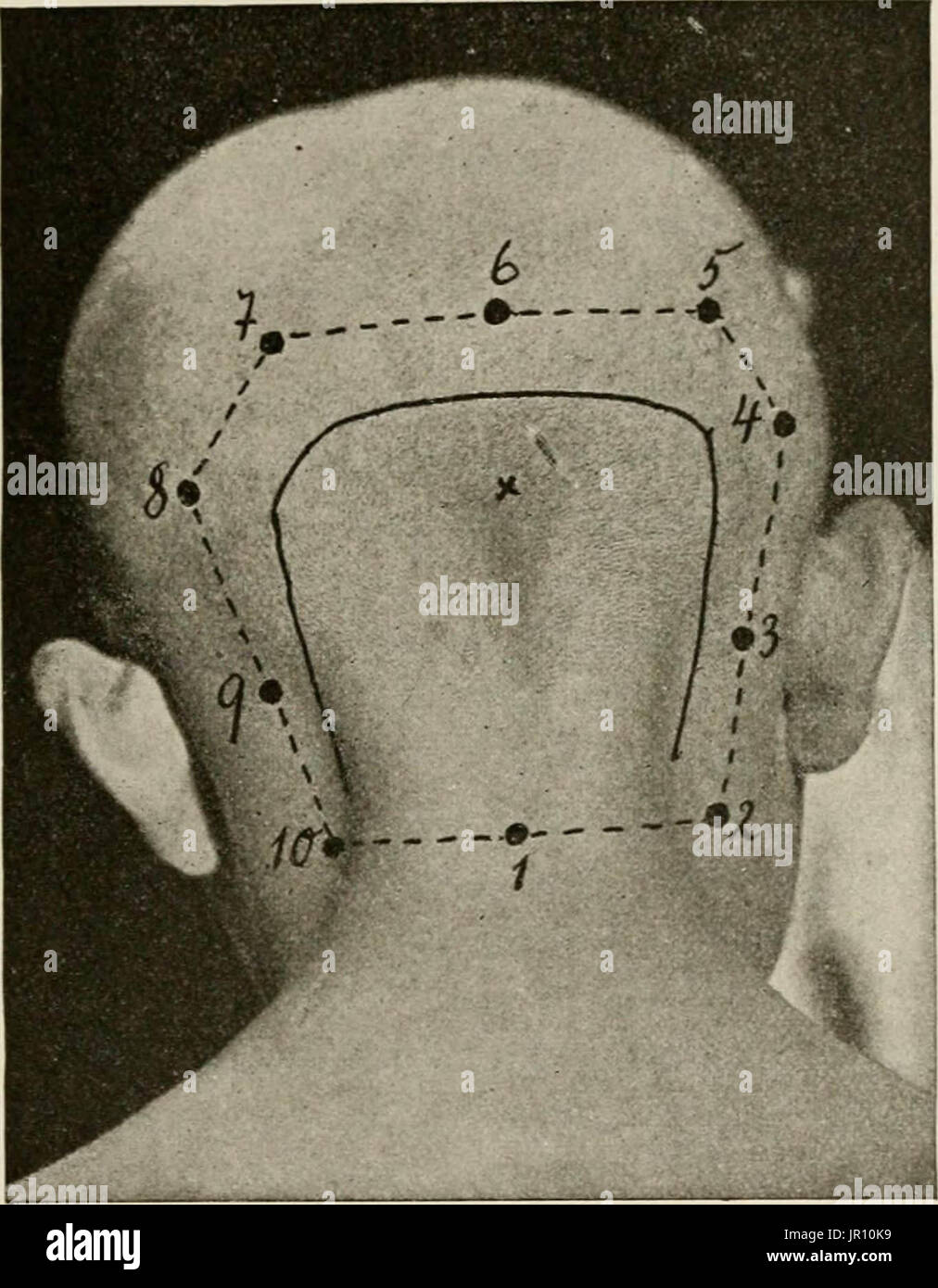 Local And Regional Anesthesia With Chapters On Spinal - 