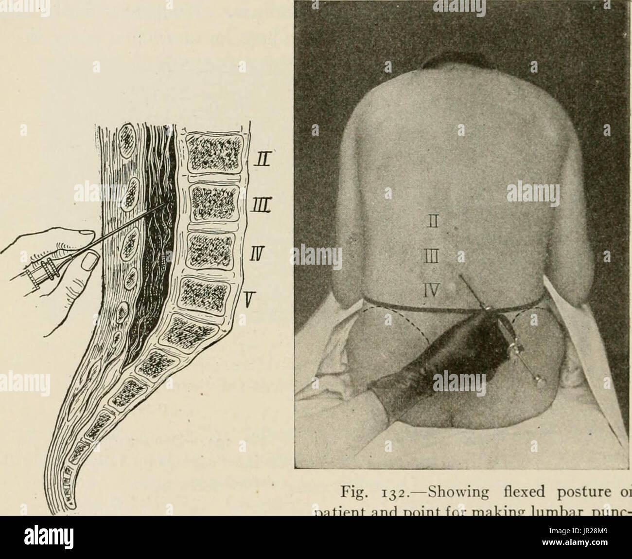 "Local and regional anesthesia; with chapters on spinal, epidural