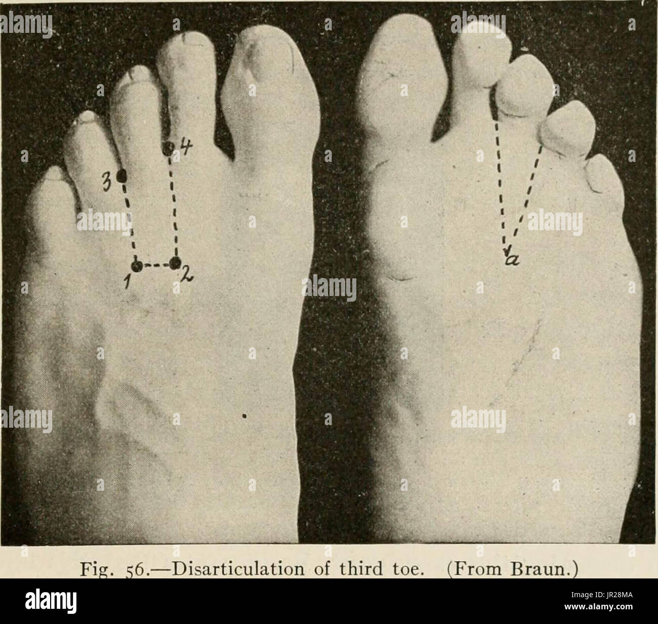 "Local and regional anesthesia; with chapters on spinal, epidural